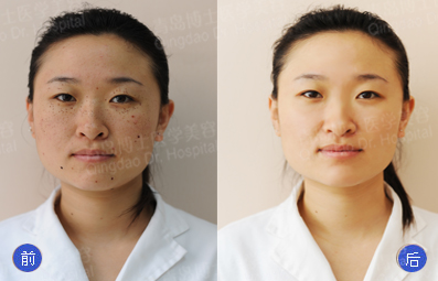 激光祛斑價(jià)格詳解與步驟指南